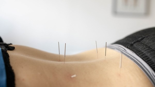 akupunktur-i-vaerloese